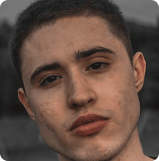 Acne (Mild to Severe)